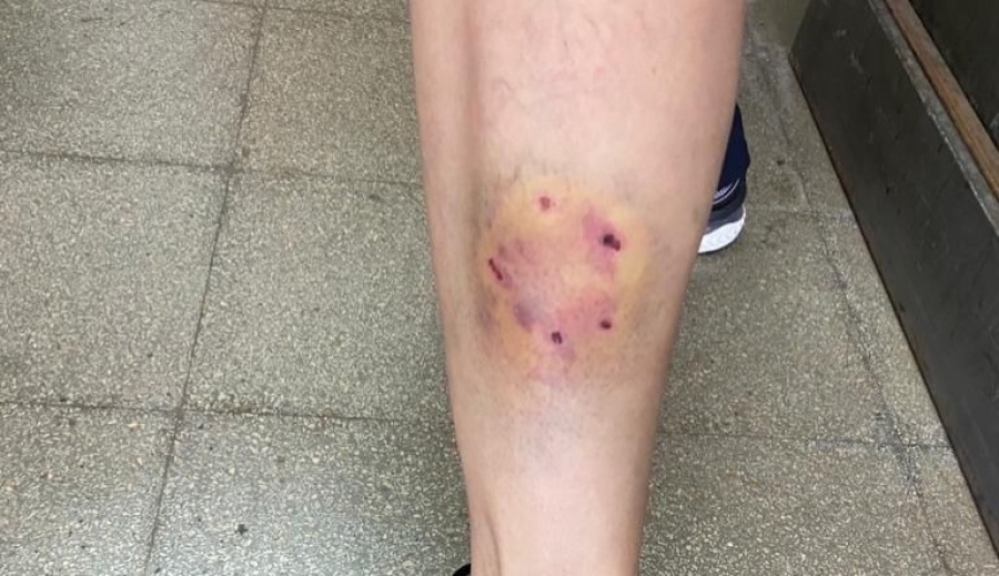 Una mujer fue mordida por un perro en El Bosque y denuncian que este hecho ya lo sufrieron varios vecinos