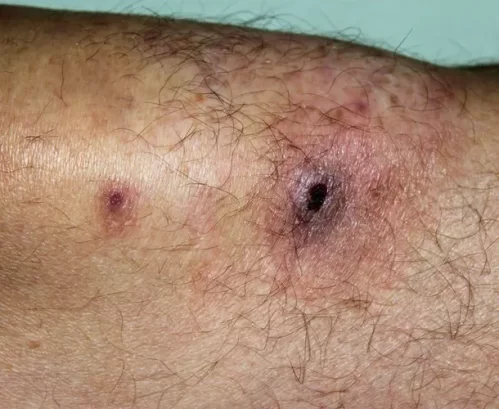 Alertan por cocaína que causa daños en las orejas y en la piel