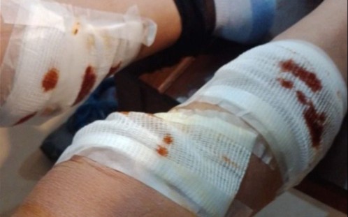 Tres pitbull sorprendieron y atacaron a una mujer cuando volvía de trabajar en La Plata: recibió diez puntos de sutura