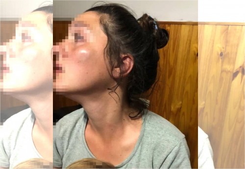 Un hombre de Los Hornos le desfiguró la cara a su pareja y ella quiso justificarlo: "Se me cayó el nene"