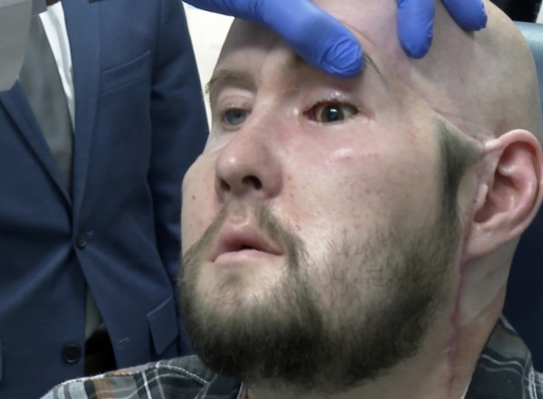 Finalizó con éxito el primer trasplante de cara y ojo del mundo: la persona había sufrido una descarga eléctrica en el rostro