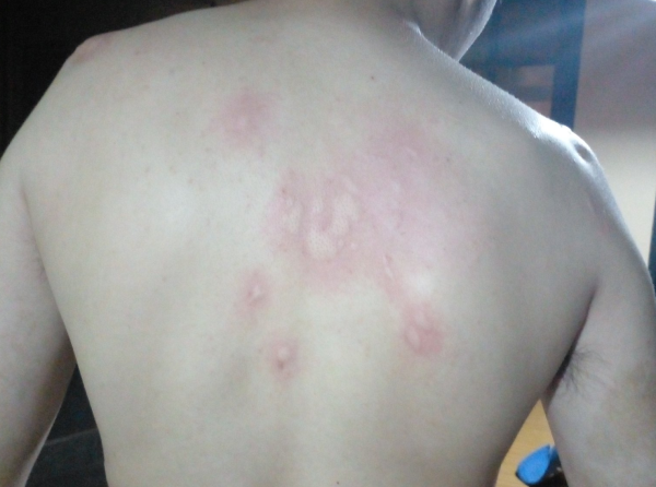 Se hartó un vecino de La Plata por los mosquitos y mostró cómo le quedó la espalda