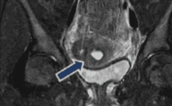 Quiso satisfacer sus 'necesidades' con un corcho, se le quedó atascado y por vergüenza estuvo tres años con el objeto adentro