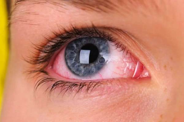 Advierten que tres de cada cuatro personas que padecen rosácea pueden sufrir compromiso ocular