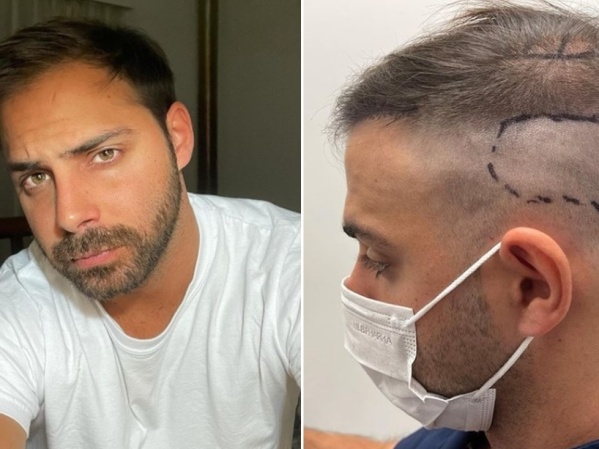 Grego Rossello mostró cómo le quedó el implante capilar: "Me pidieron que cuente un poco ya que nadie lo hace"