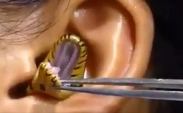 Le sacaron una serpiente del o&iacute;do a una mujer y todo qued&oacute; grabado