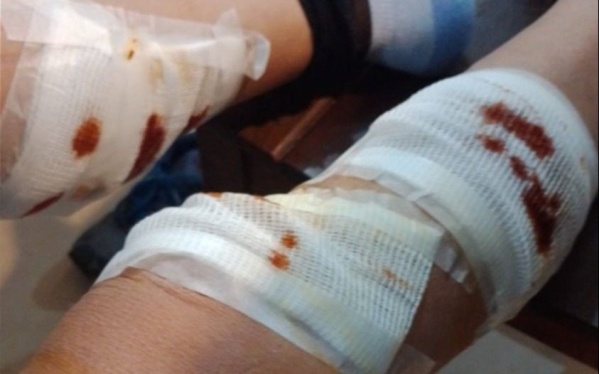 Tres pitbull sorprendieron y atacaron a una mujer cuando volvía de trabajar en La Plata: recibió diez puntos de sutura
