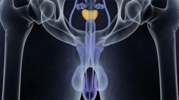 Todo lo que debes saber sobre el cáncer de próstata