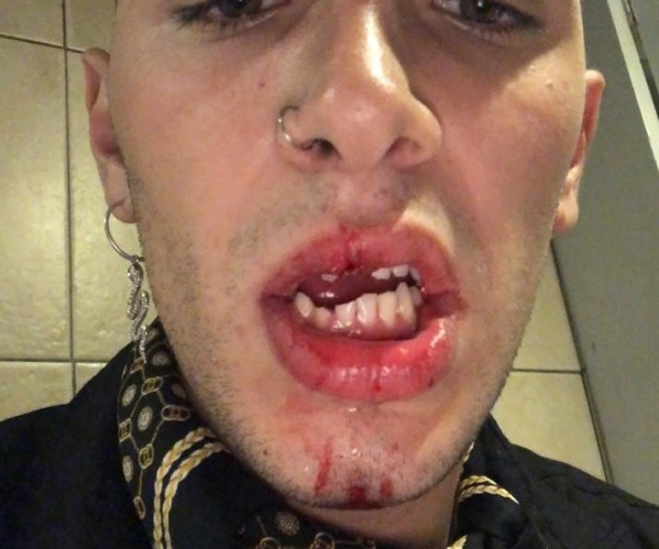 Joven platense fue brutalmente golpeado en un boliche LGBT por la &quot;patota&quot; de una influencer