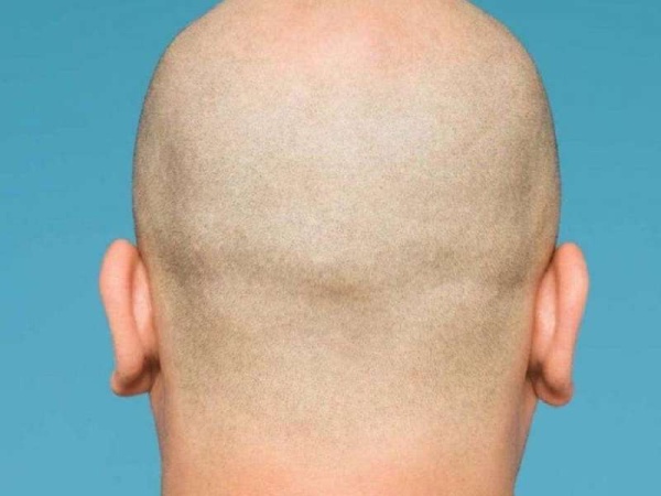 ¡Atención, pelados! afirman que los hombres con calvicie tienen un 40% más de probabilidades de padecer síntomas graves de coronavirus