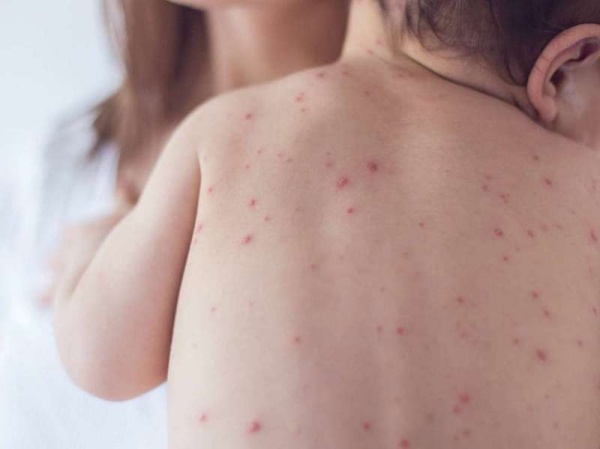 Realizan campaña de vacunación contra el sarampión en La Plata para evitar que se propague la enfermedad 