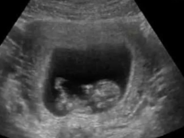 Horror por ultrasonido que muestra una beba diabólica que sonríe