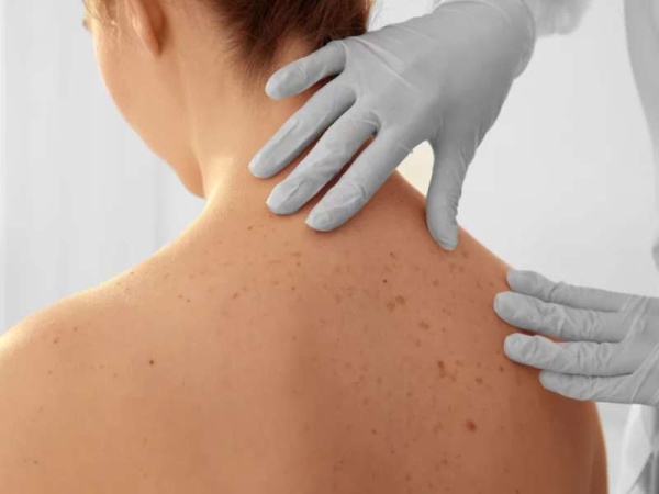 Los 5 síntomas de coronavirus que aparecen en la piel