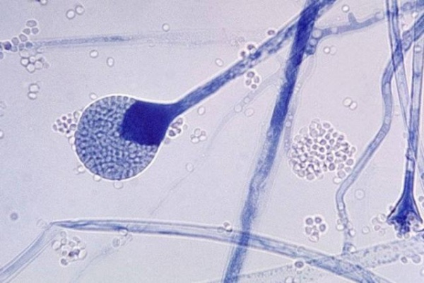 La enfermedad del "hongo negro", derivada del COVID-19 que está causando estragos en otros países