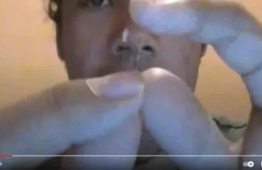 Se operó a sí mismo la nariz viendo tutoriales y casi termina en tragedia: se aplicó una anestesia veterinaria