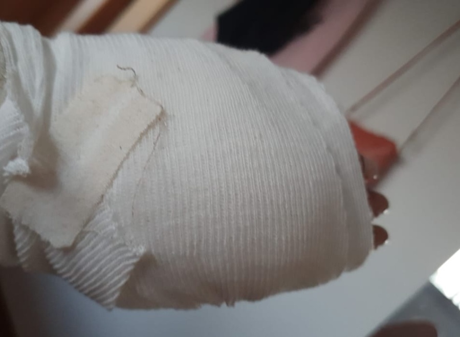 Demencial ataque de dogos en el Parque Pereyra Iraola: una mujer terminó ensangrentada y le dieron cinco puntos