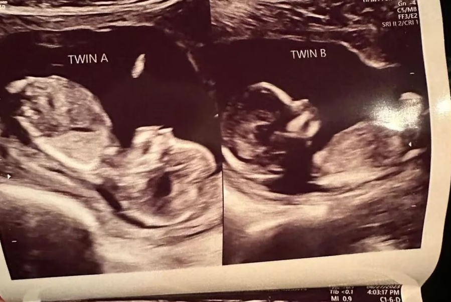 Nació con dos úteros y está embarazada en ambos: ”Nunca antes habíamos tenido una situación como esta”