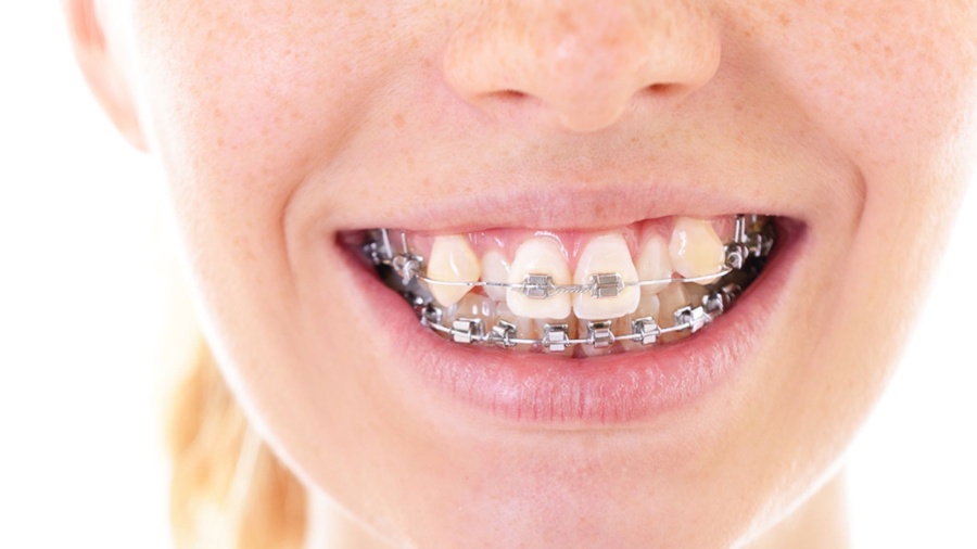 Prohibieron un tipo de brackets por ser potencialmente riesgosos para la salud