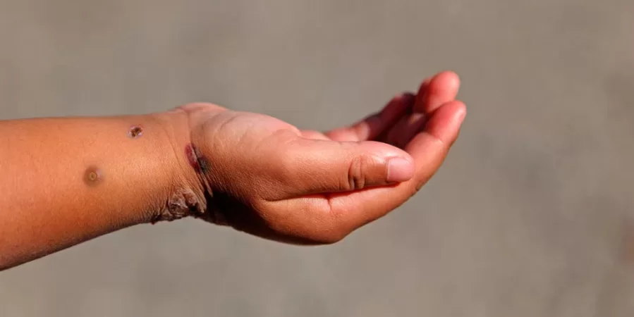 Viruela del mono en la Argentina: detectan el primer caso infantil y confirman más contagios en adultos