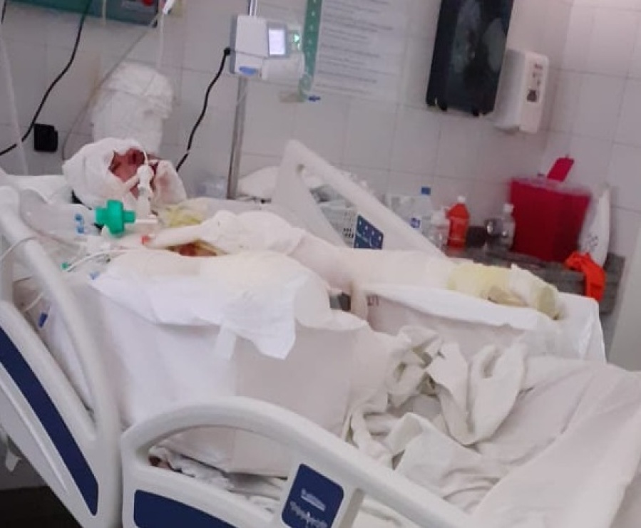 Tiene 16 años y está peleando por su vida tras haberse prendido fuego