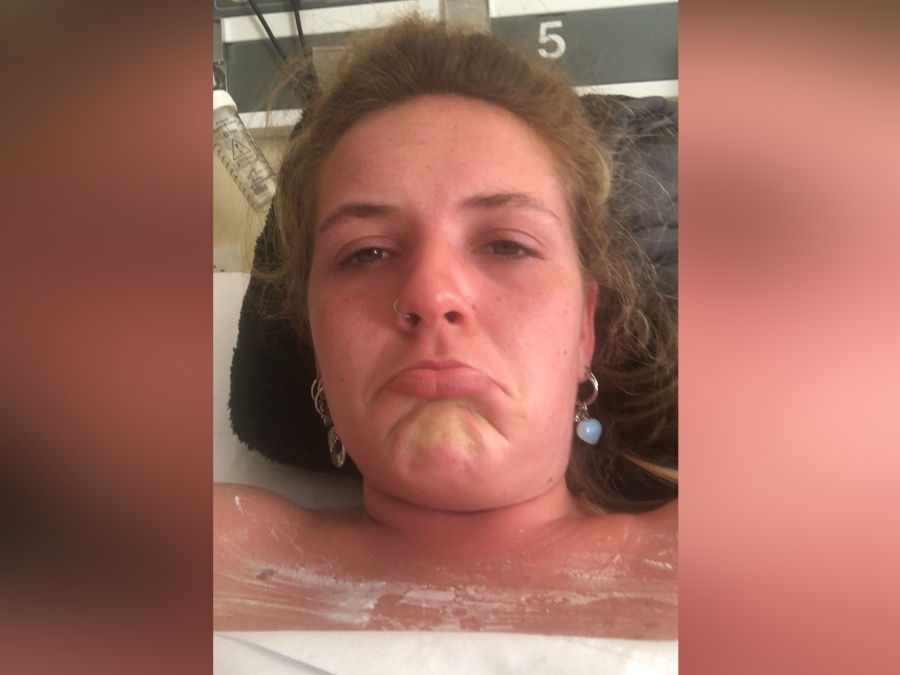 Se bronceó dos veces en un día en cama solar, terminó internada y se hizo viral: ”Había 2x1”