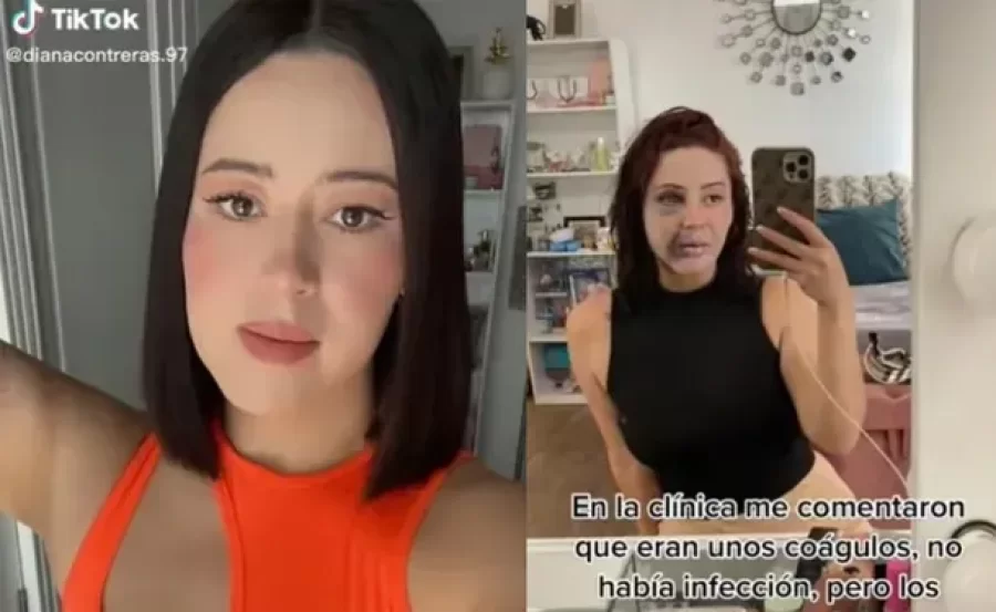 Tiktoker se hizo bichectomía y lipopapada: quedó desfigurada
