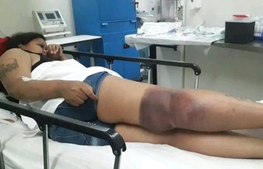 La joven que sufrió una descarga eléctrica en la estación de trenes de City Bell deberá ser operada