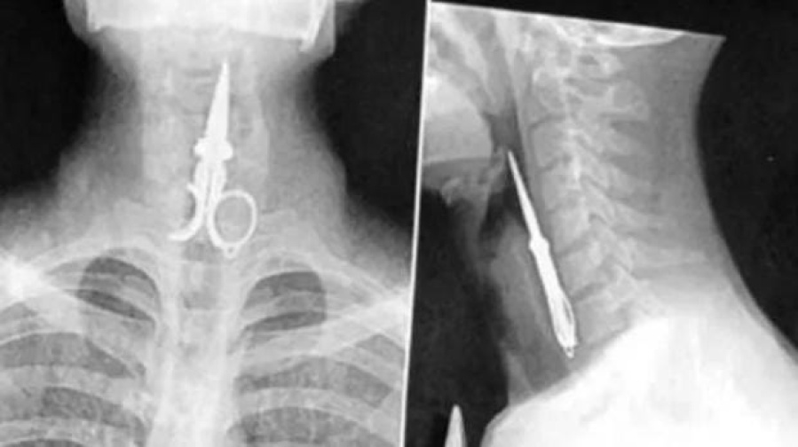 Un preso se tragó una tijera en modo de protesta y tuvieron que internarlo de urgencia