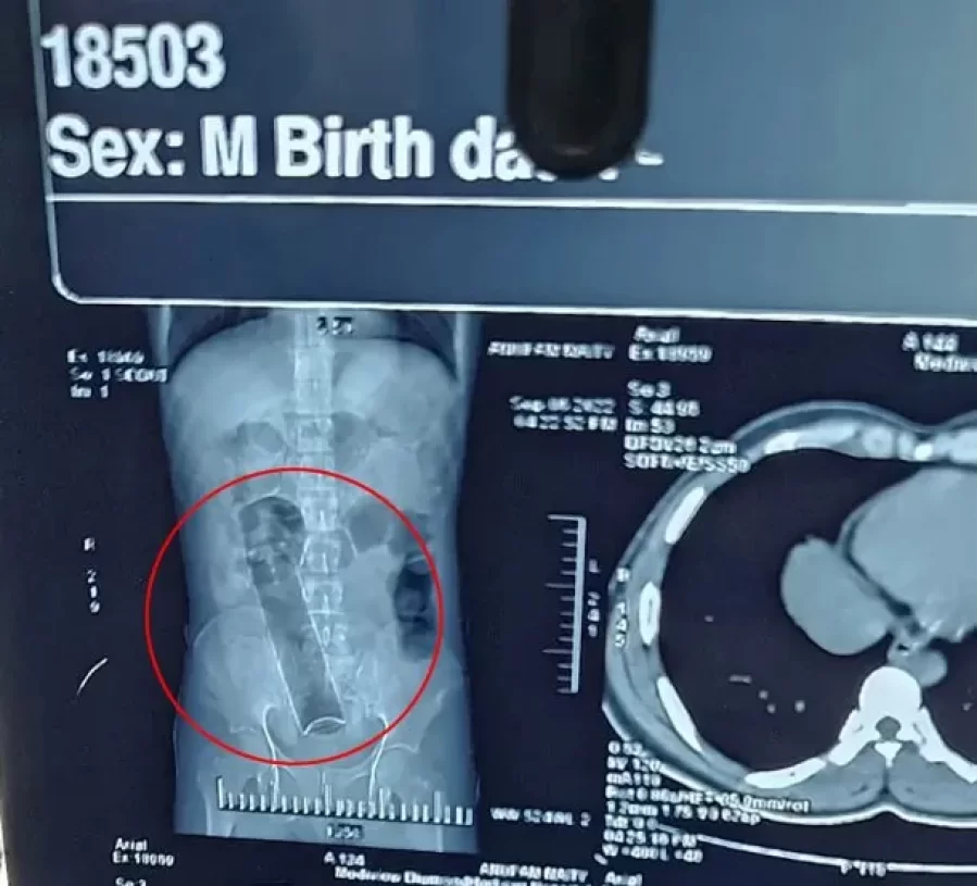 ¡Increíble! Estuvo tres semanas con un desodorante en el ano y tuvo que ser operado de urgencia