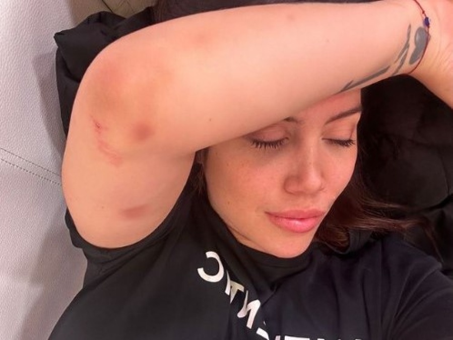 Wanda Nara sorprendió al mostrar varias lastimaduras y moretones pero llevó tranquilidad a sus seguidores: “Todo está bien”