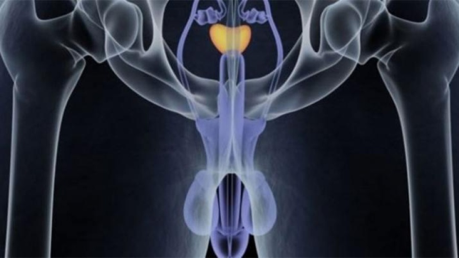 Todo lo que debes saber sobre el cáncer de próstata