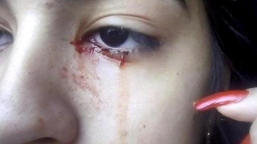 Misterio por la chica de 15 años que llora lágrimas de sangre