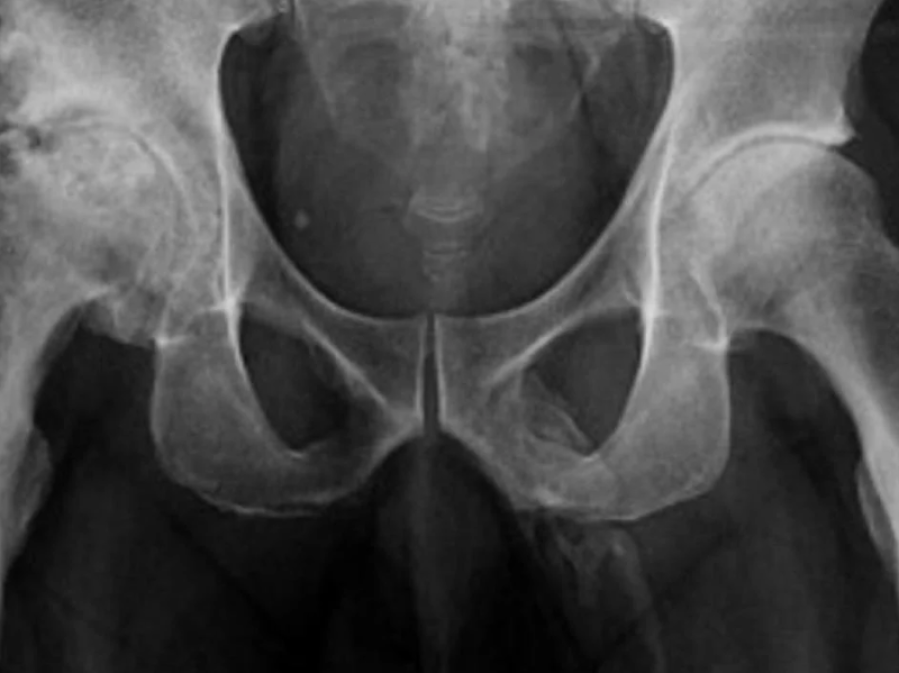 Descubrió que su pene se le estaba convirtiendo en hueso