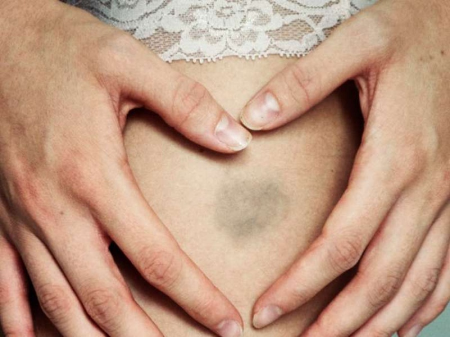 Las 4 razones por las que te aparecen moretones