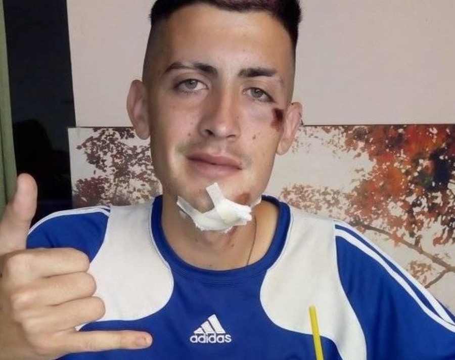 Le fracturaron la mandíbula a un joven de Berisso para robarle 2.000 pesos: ”Caí con la cara al piso y me patearon la pera”