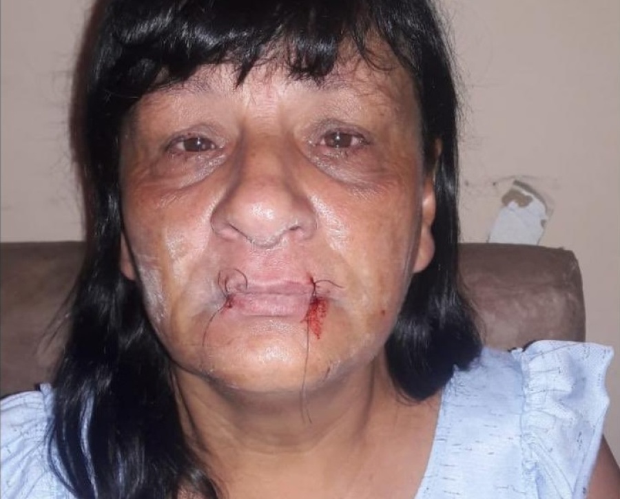 Así le cosieron la boca a Estela Sánchez, vecina de Villa Elvira que reclama por su hijo