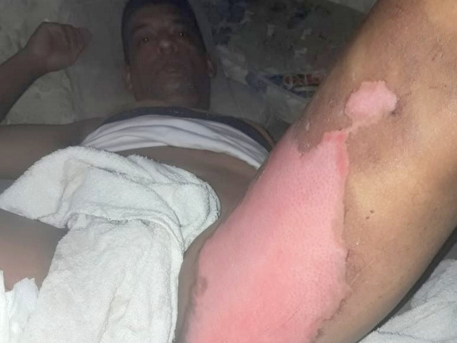 Le quedó pegada la pava, casi muere electrocutado y no lo quisieron llevar al Hospital de Melchor Romero: “No puede caminar”